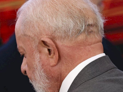 Médico de Lula descarta sequela e diz que função cerebral está intacta Médico de Lula descarta sequela e diz que função cerebral está intacta