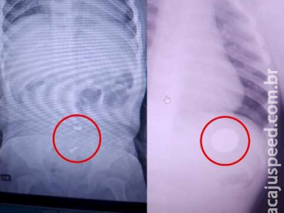 Diagnosticado com pneumonia, bebê tinha moeda e parafusos no estômago Diagnosticado com pneumonia, bebê tinha moeda e parafusos no estômago
