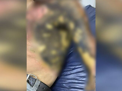 Adolescentes ateiam fogo em morador de rua em Pedro Juan Caballero Adolescentes ateiam fogo em morador de rua em Pedro Juan Caballero