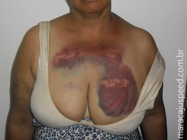 Polícia de MS pede prisão de suspeito de usar correntes para ferir cuidadora Polícia de MS pede prisão de suspeito de usar correntes para ferir cuidadora