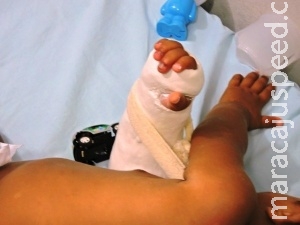 Bebê dá entrada em hospital com braço quebrado e marcas de queimadura Bebê dá entrada em hospital com braço quebrado e marcas de queimadura