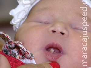 Em caso raro, bebê nasce com dente formado Em caso raro, bebê nasce com dente formado