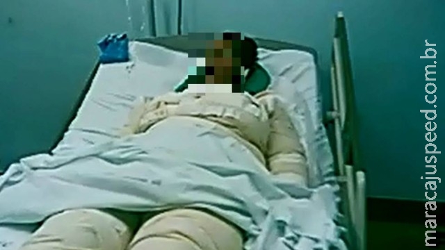 Mulher tem 80% do corpo queimado pelo marido, que é preso Mulher tem 80% do corpo queimado pelo marido, que é preso