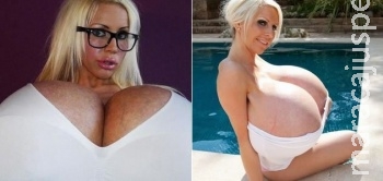 Após colocar 20 litros de silicone, mulher quer título de "maior peito do mundo"
