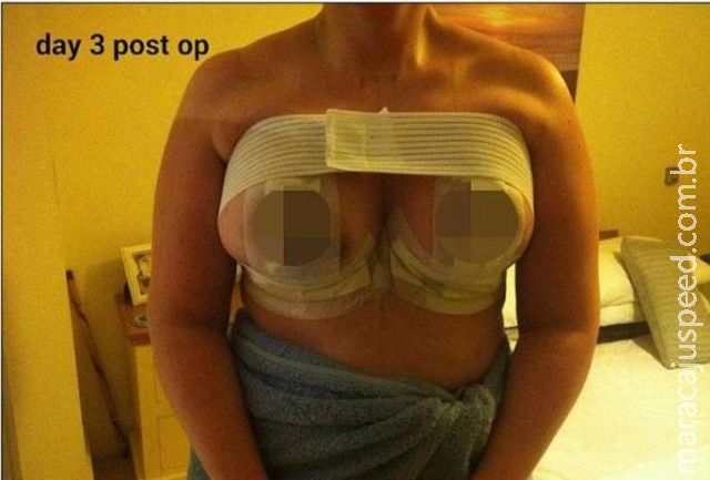 Mulher perde parte dos seios por necrose após colocar silicone Mulher perde parte dos seios por necrose após colocar silicone