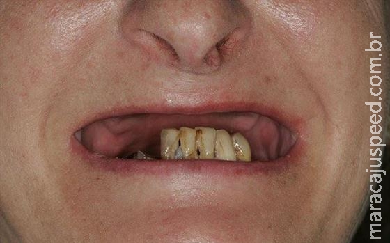Mulher acorda da anestesia e descobre que ficou banguela Mulher acorda da anestesia e descobre que ficou banguela