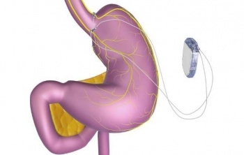 Contra obesidade, EUA aprovam uso de "marca-passo" para o estômago