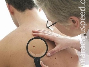Não passa protetor? Cuide-se para não ser pego de surpresa pelo câncer de pele Não passa protetor? Cuide-se para não ser pego de surpresa pelo câncer de pele