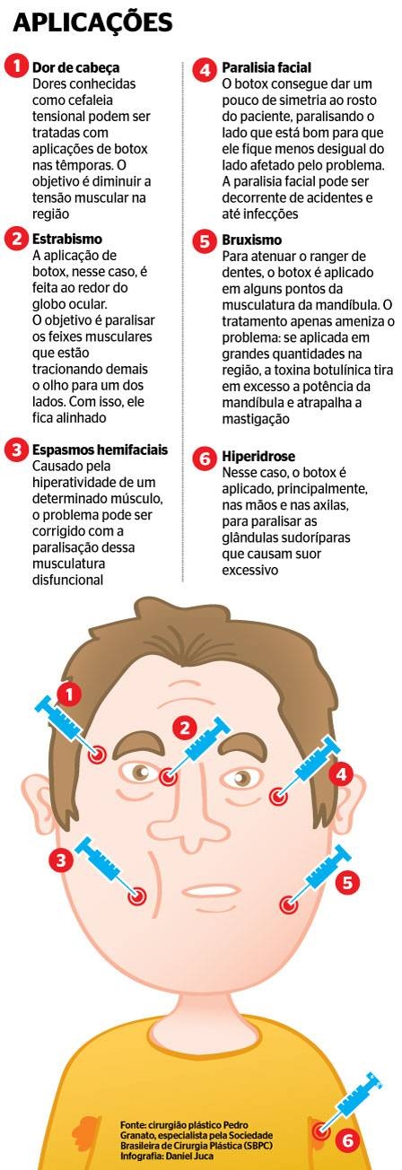 Botox também serve para tratar dores de cabeça, paralisia facial e bruxismo Botox também serve para tratar dores de cabeça, paralisia facial e bruxismo