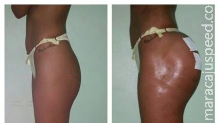 Vendedora acaba no hospital após procedimento para aumentar o bumbum Vendedora acaba no hospital após procedimento para aumentar o bumbum