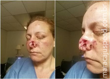 Mulher tem pedaço do nariz arrancado em briga com ex-namorado; imagens fortes Mulher tem pedaço do nariz arrancado em briga com ex-namorado; imagens fortes