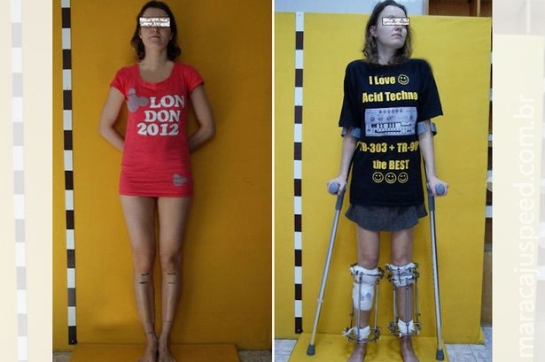 Mulher passa por cirurgia para aumentar as pernas após ser considerada baixa para carreira de modelo Mulher passa por cirurgia para aumentar as pernas após ser considerada baixa para carreira de modelo