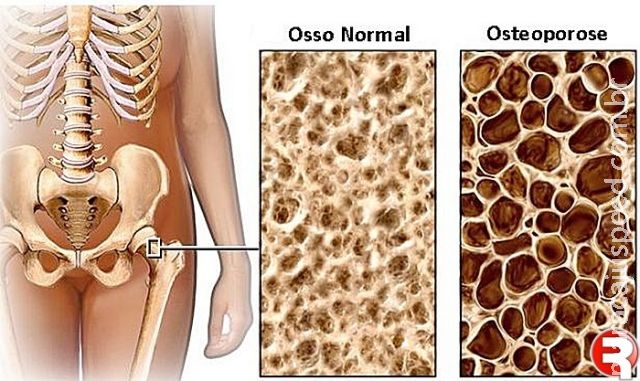Campanha nacional alerta para risco de segunda fratura causada pela osteoporose