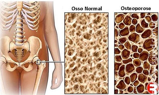 Campanha nacional alerta para risco de segunda fratura causada pela osteoporose Campanha nacional alerta para risco de segunda fratura causada pela osteoporose