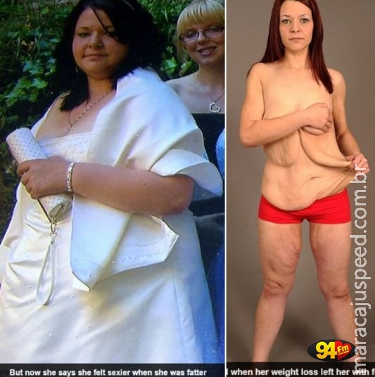 Após emagrecer 57 kg, jovem desabafa: “perder peso destruiu minha vida sexual” Após emagrecer 57 kg, jovem desabafa: “perder peso destruiu minha vida sexual”