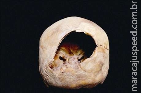Arqueólogos encontram múmia que passou por cirurgia cerebral Arqueólogos encontram múmia que passou por cirurgia cerebral