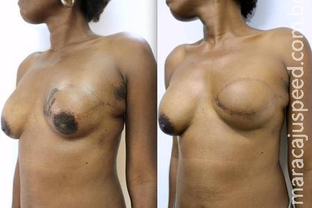Tatuador brasileiro cria projeto gratuito para recuperar autoestima de pacientes de câncer de mama Tatuador brasileiro cria projeto gratuito para recuperar autoestima de pacientes de câncer de mama