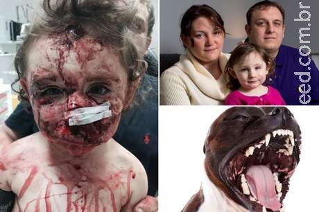Atacada por cão, menina britânica leva 240 pontos no rosto Atacada por cão, menina britânica leva 240 pontos no rosto