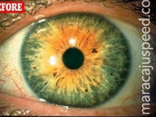 Medicamento para aumentar os cílios está transformando olhos verdes em castanhos, diz paciente 