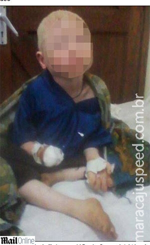 Menino albino de seis anos tem a mão decepada Menino albino de seis anos tem a mão decepada