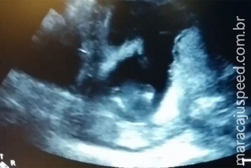 Vídeo de Bebê batendo palmas no ultrassom faz sucesso na web Vídeo de Bebê batendo palmas no ultrassom faz sucesso na web