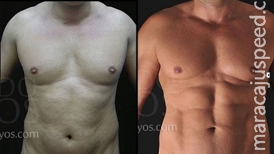 Tanquinho de bisturi: lipo cria barriga sarada e com gominhos