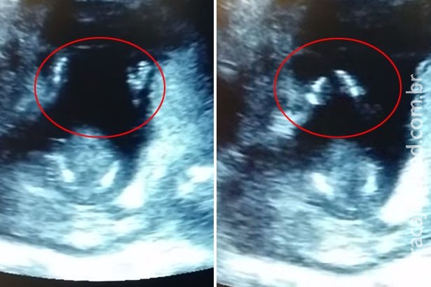 Feto bate palmas enquanto mãe canta canções de ninar durante exame de ultrassom Feto bate palmas enquanto mãe canta canções de ninar durante exame de ultrassom