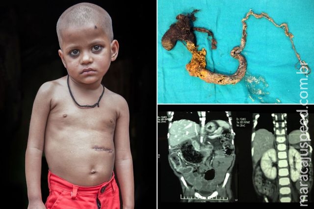 Menino com síndrome rara tem enorme bola de pelos retirada de seu estômago Menino com síndrome rara tem enorme bola de pelos retirada de seu estômago