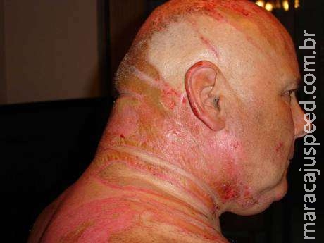 Britânico é atacado com água fervente por mulher ao desejar ver túmulo de ex Britânico é atacado com água fervente por mulher ao desejar ver túmulo de ex