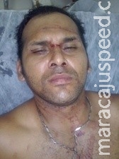 Motociclista não enxerga linha com cerol e sofre vários ferimentos no rosto 