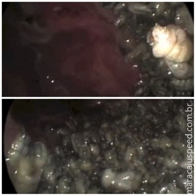 Vídeo nojento mostra médicos removendo mais de 100 vermes comedores de carne de nariz de paciente Vídeo nojento mostra médicos removendo mais de 100 vermes comedores de carne de nariz de paciente