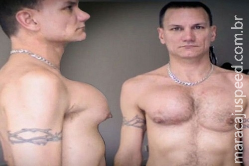 Cirurgia estética dá errado e homem fica com seio Cirurgia estética dá errado e homem fica com seio