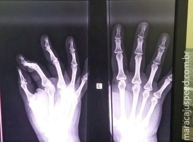 Grávida se irrita com demora e quebra dedo de servidora em posto de saúde Grávida se irrita com demora e quebra dedo de servidora em posto de saúde