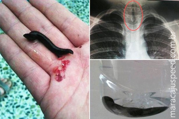 Menino sente falta de ar e médicos descobrem sanguessuga vivendo dentro de sua garganta Menino sente falta de ar e médicos descobrem sanguessuga vivendo dentro de sua garganta