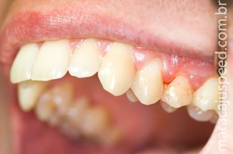  Manual da periodontite: a doença que causa perda dental