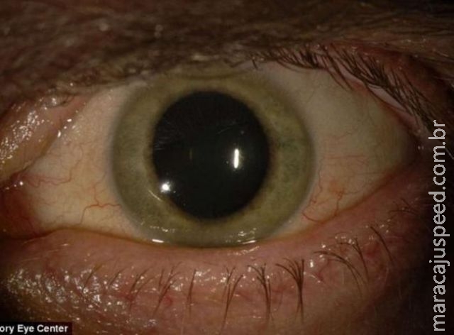 Curado, americano tem ebola nos olhos e órgão muda de cor Curado, americano tem ebola nos olhos e órgão muda de cor