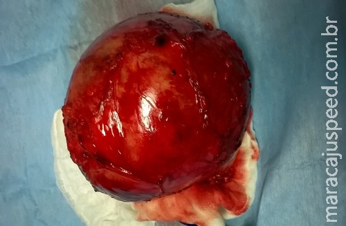 Homem vai a médico reclamando de tosse e descobre ter tumor de 5kg Homem vai a médico reclamando de tosse e descobre ter tumor de 5kg