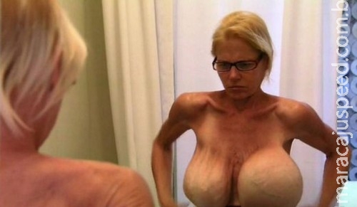 Mulher superturbinada é operada após silicone estourar Mulher superturbinada é operada após silicone estourar