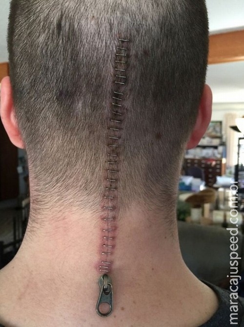 Homem reage com humor a cirurgia para retirar tumor no cérebro Homem reage com humor a cirurgia para retirar tumor no cérebro