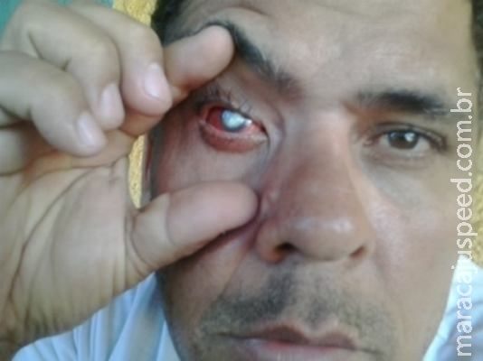 Homem perde visão em Maracaju, após médico fazer limpeza com cotonete