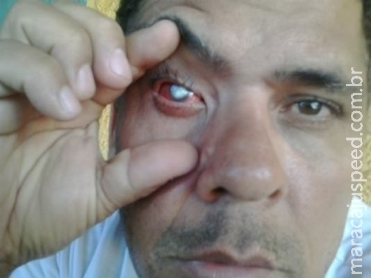 Homem perde visão em Maracaju, após médico fazer limpeza com cotonete Homem perde visão em Maracaju, após médico fazer limpeza com cotonete