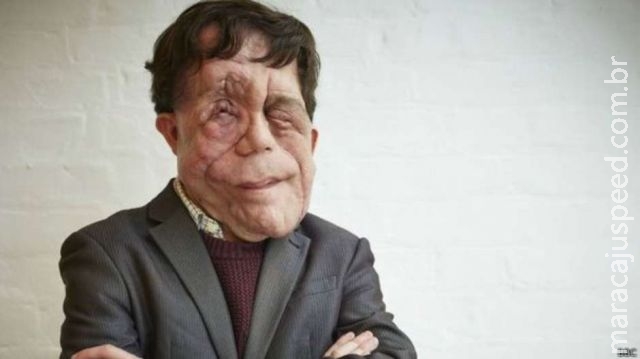 Britânico desfigurado conta cotidiano de olhares e agressões Britânico desfigurado conta cotidiano de olhares e agressões