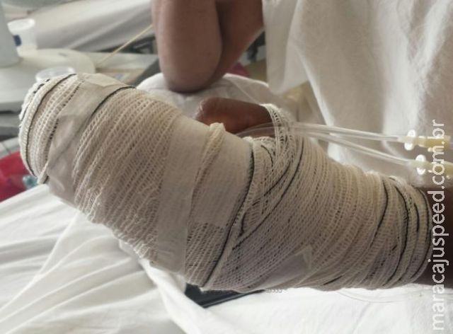 Paciente que "acordou sem dedos" tem digital costurada em dedo amputado Paciente que "acordou sem dedos" tem digital costurada em dedo amputado