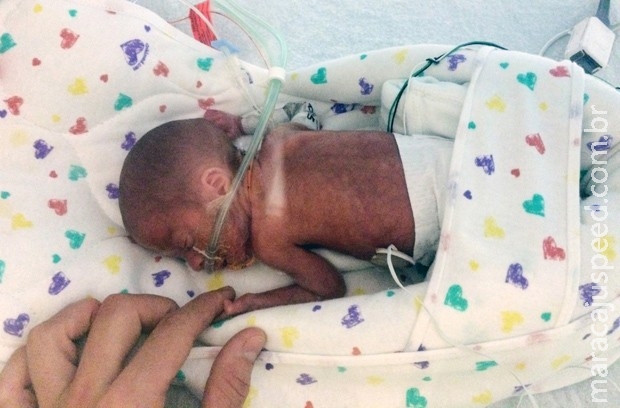Bebê nasce prematuro com apenas 680 g durante cruzeiro e sobrevive Bebê nasce prematuro com apenas 680 g durante cruzeiro e sobrevive