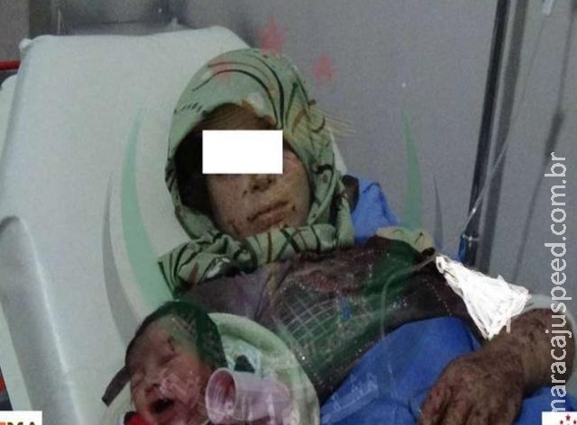 Síria: grávida ferida dá à luz bebê com marca de estilhaços