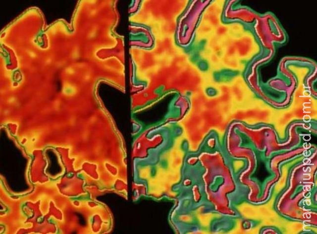 Cientistas levantam hipótese de transmissão do Alzheimer Cientistas levantam hipótese de transmissão do Alzheimer