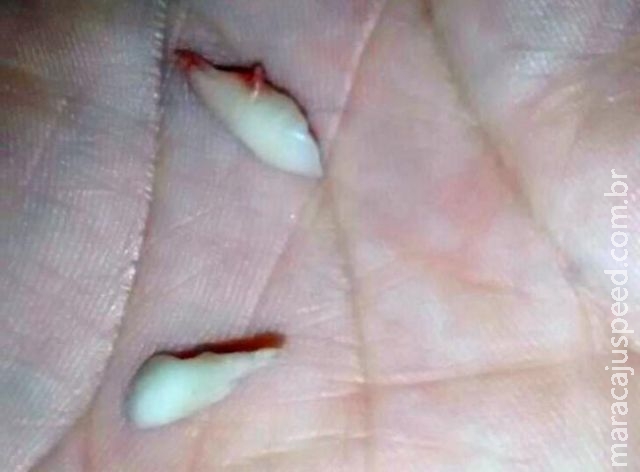 Cadeira de posto de saúde quebra e criança de 7 anos perde dois dentes Cadeira de posto de saúde quebra e criança de 7 anos perde dois dentes