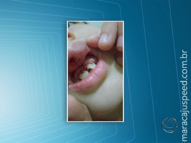 Criança quebra dente em escola de MS e mãe reclama de falta de aviso Criança quebra dente em escola de MS e mãe reclama de falta de aviso