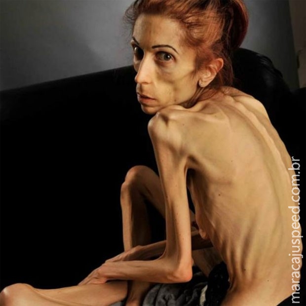 Americana que pesava 18 kg mostra recuperação pós-anorexia bancada com doações online Americana que pesava 18 kg mostra recuperação pós-anorexia bancada com doações online