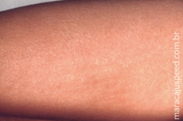Manchas vermelhas pelo corpo: pode ser escarlatina? Manchas vermelhas pelo corpo: pode ser escarlatina?